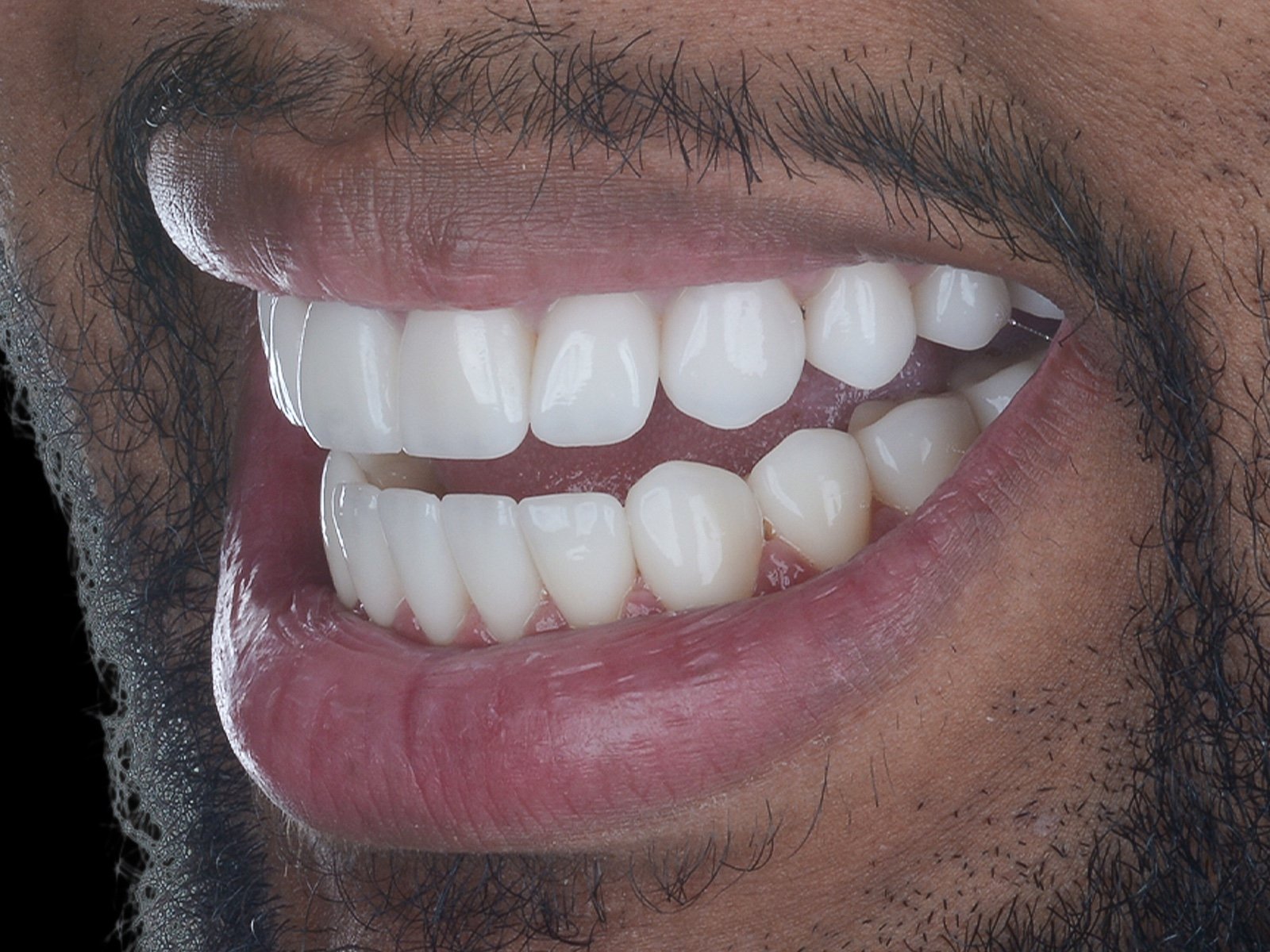 Sorriso com lentes visto em perspectiva lateral